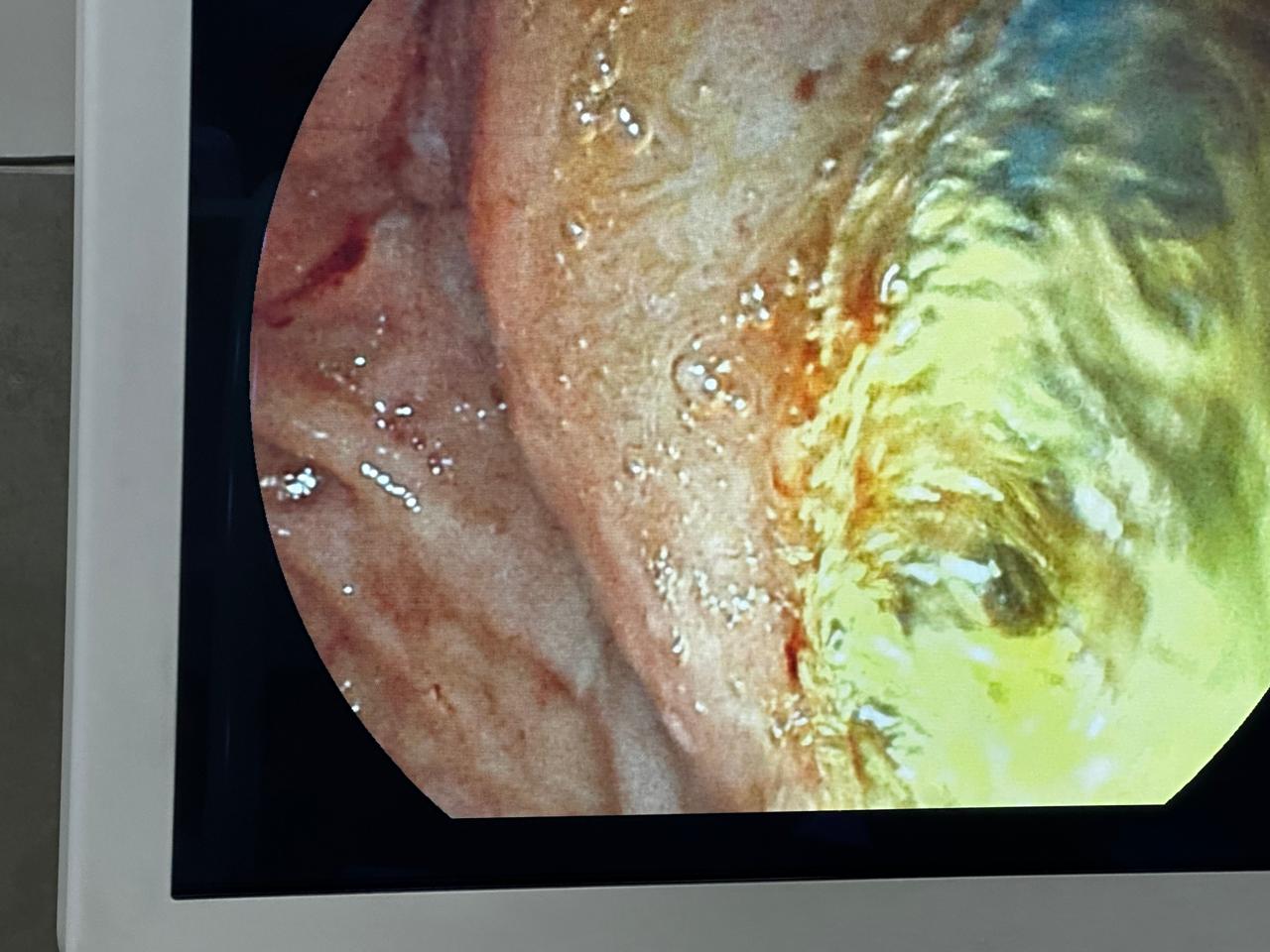 ERCP