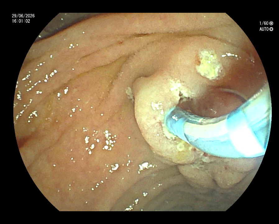 ERCP